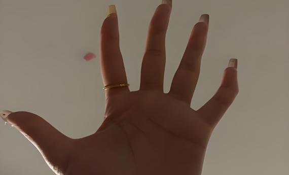 女子长期用小拇指托手机，十年后手指变形！医生：这是典型的“手机手”